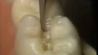 The Amalgam Proximal Box Cavity Preparation [upl. by Eimmat]