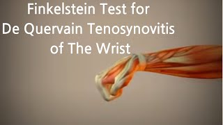 The Finkelstein Test For De Quervains Tenosynovitis [upl. by Atsirk]