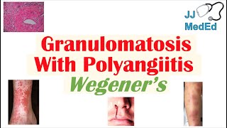 Granulomatosis with Polyangiitis Wegener’s granulomatosis  Symptoms Diagnosis Treatment [upl. by Jillene]