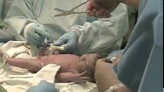 Twins Birth by Cesarean nongraphic  emergency delivery of multiples attended by doula [upl. by Abagael]