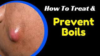 How to Treat and Prevent Boils  Head Throat Armpit  Kasoa TV [upl. by Drawde]