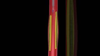 Learn How Angioplasty Works Animated Video [upl. by Osher]