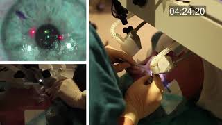 Realtime uncut unedited LASIK procedure live with real sound [upl. by Tine235]