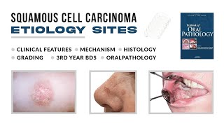 Squamous cell carcinoma  Oral pathology Lectures Disorders of oral cavity Lecture part 1 [upl. by Robin]