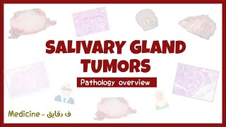 Salivary glands tumors  Pleomorphic adenoma Warthin tumor pathology overview شرح [upl. by Suoinuj]