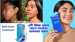 রাতারাতি ব্রন দূর করার জেল কতটা কার্যকরী Differin Gel Acne Treatment  khadija begum [upl. by Anna-Maria]