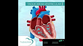 Taquicardia Ventricular [upl. by Rennoc]