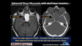 Sphenoid Sinus Mucous Retention Cyst vs Mucocele correction Slide 5 [upl. by Eissahc94]