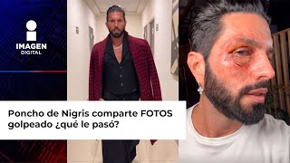 Poncho de Nigris comparte FOTOS golpeado ¿qué le pasó [upl. by Neehahs]