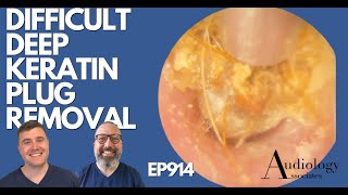 DIFFICULT DEEP KERATIN PLUG REMOVAL  EP914 [upl. by Yentnuoc]