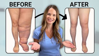 The Best Treatment for Lymphedema [upl. by Aicnatsnoc]