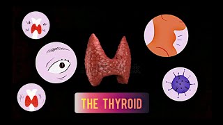 THYROID  HYPOTHYROIDISM Cretinism amp Myxedema [upl. by Thorley]