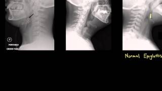 Epiglottitis Diagnosis and Treatment [upl. by Leinehtan]