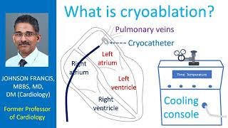 What is cryoablation [upl. by Reichel]