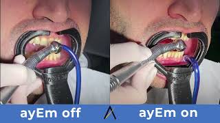 ayEm 360 Aerosol Suction Performance [upl. by Bolme]