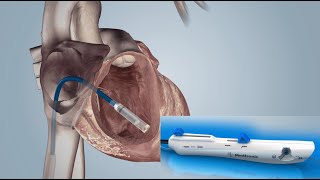 Leadless Pacemaker PPM Implantation [upl. by Adnohsar]