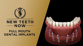 Full Mouth Dental Implant Procedure [upl. by Ymot]