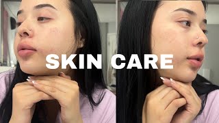 Skincare Routine for Acne Prone Skin  Morning amp Night Skin Care Routine  Skin specialist in Delhi [upl. by Ellinej]