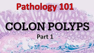 Colon Polyps  Part 1 Pathology 101 [upl. by Jamin]