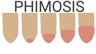 Phimosis  IntroductionTypesCausesRisk factorsSings amp SymptomsDiagnostic Test and Management [upl. by Othilia]