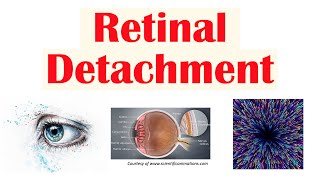 Retinal Detachment  Types Risk Factors Pathophysiology Signs amp Symptoms Diagnosis Treatment [upl. by Ahgiela]