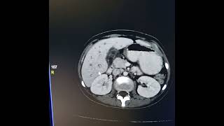 Liver abscess  Periportal haloPeriportal collar sign [upl. by Carmella]