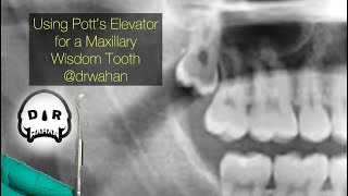 Using Pott’s Elevator to Help Extract a Maxillary Wisdom Tooth drwahan [upl. by Assiluy]