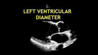 Ejection Fraction Practice On Echocardiogram [upl. by Culver]