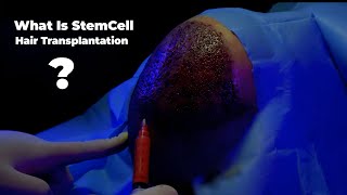 What is stem cell hair transplantation [upl. by Rudyard]