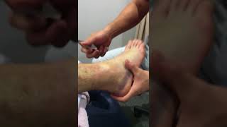 Graston Technique on a grade 2 ankle sprain [upl. by Rentsch]