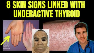 Doctor explains 8 SKIN SIGNS linked with HYPOTHYROIDISM aka underactive thyroid [upl. by Doretta]