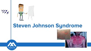 StevensJohnson Syndrome Causes Diagnosis Differentials Symptoms and Treatment [upl. by Assilac688]