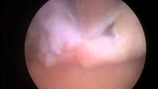 Removal of a large fundal polyp using a hysteroscopic morcellator [upl. by Ahkihs]