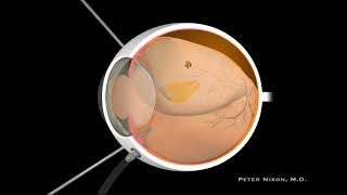 Posterior Vitreous Detachment PVD and Retinal Detachment RD [upl. by Ahtael]