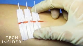 NeedleLess Alternative To Stitches [upl. by Lahcar]