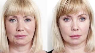 How to Tighten Skin with ULTRAcel [upl. by Mayrim]