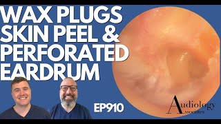 EAR WAX PLUGS SKIN PEEL amp PERFORATED EARDRUM  EP910 [upl. by Sadiras]