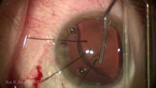 Capsular Tension Segment CTS Surgical Technique for Dislocated Cataract by Ike Ahmed [upl. by Aniale]