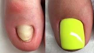 Nails Transformation Compilation  Ugly Feet And Toenails Transformation [upl. by Gratianna]