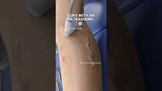 Super glue for your veins 3D Animation [upl. by Nomzed367]