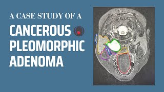 Can benign parotid tumors turn cancerous  Pleomorphic adenoma case study [upl. by Ananna275]