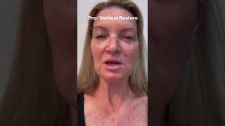 PostFacelift Plastic Surgery Recovery Process Plastic Surgeon TURNS BACK TIME [upl. by Felicity]