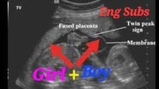 Anterior placenta means baby boy or girl  Anterior placenta baby gender  Boy n Girl Twin Pregnancy [upl. by Bensen576]