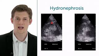 How To Evaluate Hydronephrosis In Point of Care Ultrasound [upl. by Auria]