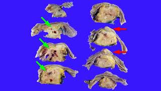 Two causes of obstructive jaundice amp chronic pancreatitis  adenomyoma amp autoimmune pancreatitis [upl. by Apfel]