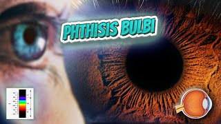 Phthisis bulbi  Your EYEBALLS  EYNTK 👁️👁️💉😳💊🔊💯✅ [upl. by Annodas]