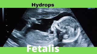 Hydrops Fetalis  Ultrasound  Anomaly  Case [upl. by Idzik]