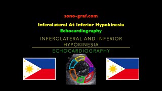 Echocardiography  Inferolateral At Inferior Hypokinesia [upl. by Elsi]