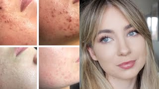 HOW I CLEARED MY HORMONAL ACNE NATURALLY 2020  FAST RESULTS TO CLEAR YOUR SKIN [upl. by Gabel]