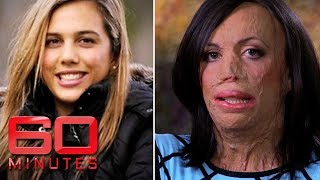 Turia Pitt was burned alive during an ultramarathon  60 Minutes Australia [upl. by Elmira]